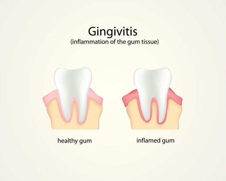 Gingivitis & Periodontitis